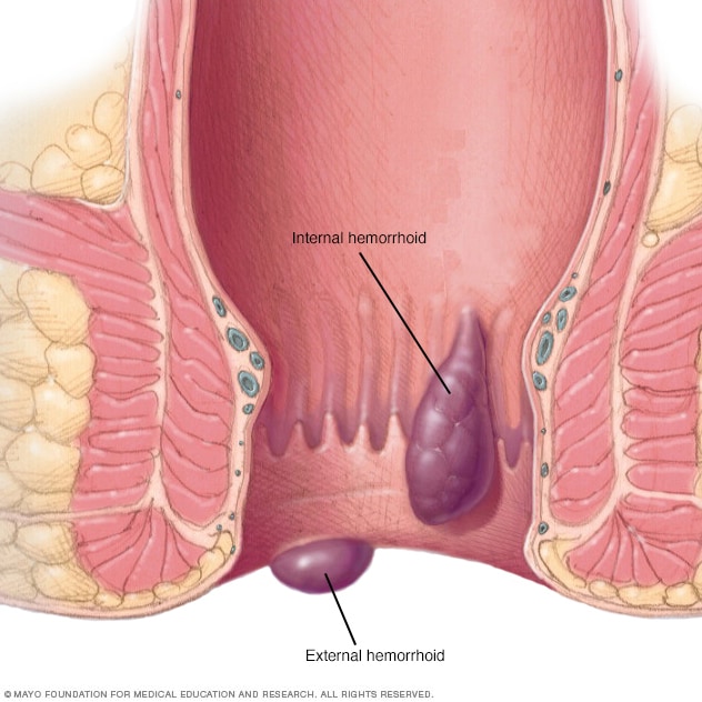 Haemorrhoids Tan Tock Seng Hospital 